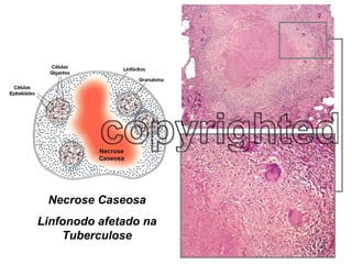 Necrose Caseosa Linfonodo afetado na Tuberculose 