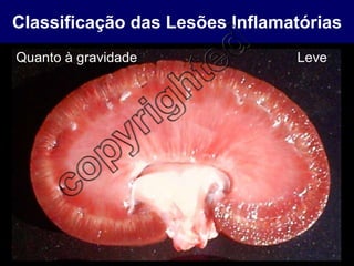 Classificação das Lesões Inflamatórias Quanto à gravidade Leve 