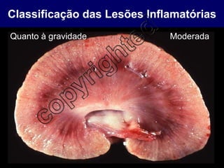 Classificação das Lesões Inflamatórias Quanto à gravidade Moderada 