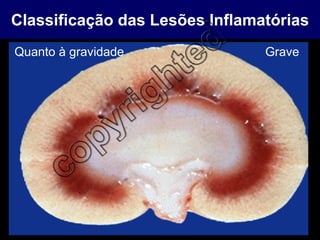 Classificação das Lesões Inflamatórias Quanto à gravidade Grave 