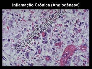 Inflamação Crônica (Angiogênese) 