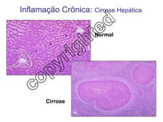 Inflamação Crônica:  Cirrose Hepática Normal Cirrose 