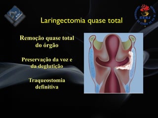 Remoção quase total
do órgão
Preservação da voz e
da deglutição
Traqueostomia
definitiva
Laringectomia quase total
 
