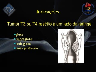 Indicações
Tumor T3 ou T4 restrito a um lado da laringe
#glote
# supraglote
# sub-glote
# seio piriforme
 