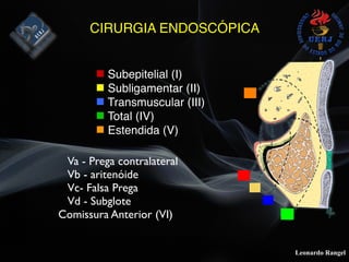 Leonardo Rangel
CIRURGIA ENDOSCÓPICA
" Subepitelial (I)
" Subligamentar (II)
" Transmuscular (III)
" Total (IV)
" Estendida (V)
Va - Prega contralateral
Vb - aritenóide
Vc- Falsa Prega
Vd - Subglote
Comissura Anterior (VI)
 