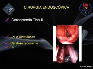 Leonardo Rangel
CIRURGIA ENDOSCÓPICA
Cordectomia Tipo II
Dx e Terapêutico
Ceratose recorrente
T1
 