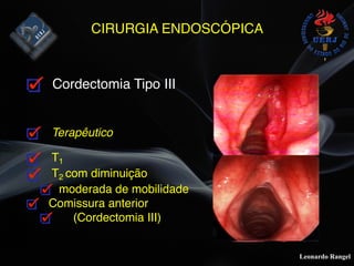 Leonardo Rangel
CIRURGIA ENDOSCÓPICA
Cordectomia Tipo III
Terapêutico
T1
T2 com diminuição
moderada de mobilidade
Comissura anterior
(Cordectomia III)
 