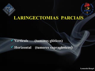 Leonardo Rangel
! Verticais (tumores glóticos)
! Horizontal (tumores supraglóticos)
LARINGECTOMIAS PARCIAIS
 