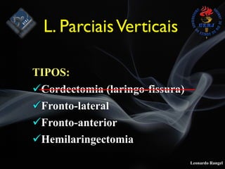 Leonardo Rangel
TIPOS:
!Cordectomia (laringo-fissura)
!Fronto-lateral
!Fronto-anterior
!Hemilaringectomia
L. ParciaisVerticais
 