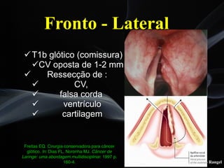 Leonardo Rangel
!T1b glótico (comissura)
!CV oposta de 1-2 mm
! Ressecção de :
! CV,
! falsa corda
! ventrículo
! cartilagem
Freitas EQ. Cirurgia conservadora para câncer
glótico. In: Dias FL, Noronha MJ. Câncer de
Laringe: uma abordagem multidisciplinar. 1997 p.
160-4.
Fronto - Lateral
 