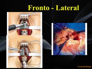 Leonardo Rangel
Fronto - Lateral
 