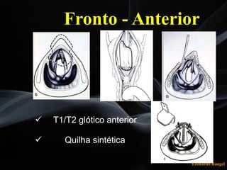 Leonardo Rangel
! T1/T2 glótico anterior
! Quilha sintética
Fronto - Anterior
 