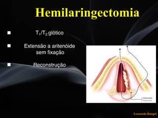 Leonardo Rangel
" T1/T2 glótico
" Extensão a aritenóide
sem ﬁxação
" Reconstrução
Hemilaringectomia
 
