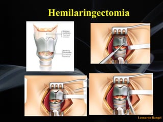 Leonardo Rangel
Hemilaringectomia
 