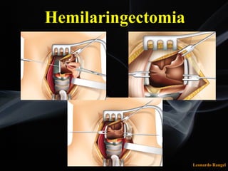 Leonardo Rangel
Hemilaringectomia
 