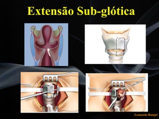 Leonardo Rangel
Extensão Sub-glótica
 
