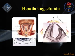 Leonardo Rangel
Hemilaringectomia
 