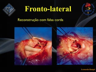 Leonardo Rangel
Reconstrução com falsa corda
Fronto-lateral
 