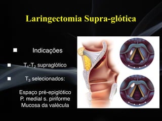 " Indicações
" T1-T2 supraglótico
" T3 selecionados:
Espaço pré-epiglótico
P. medial s. piriforme
Mucosa da valécula
Laringectomia Supra-glótica
 