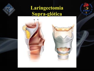 Laringectomia
Supra-glótica
 
