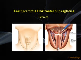 Leonardo Rangel
Técnica
Laringectomia Horizontal Supraglótica
 