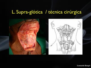 Leonardo Rangel
L. Supra-glótica / técnica cirúrgica
 