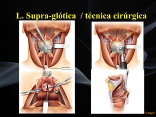 Leonardo Rangel
L. Supra-glótica / técnica cirúrgica
 