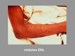nódulos ENL
 