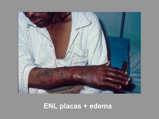 ENL placas + edema
 