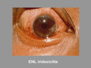 ENL iridociclite
 