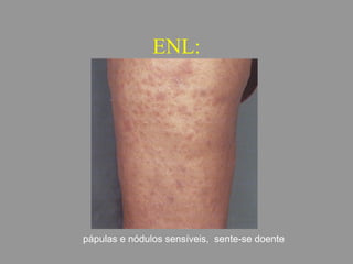 ENL:
pápulas e nódulos sensíveis, sente-se doente
 