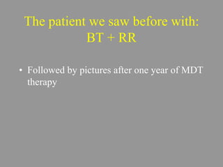 The patient we saw before with:
BT + RR
• Followed by pictures after one year of MDT
therapy
 