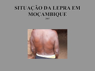 SITUAÇÃO DA LEPRA EM
MOÇAMBIQUE
2007
 