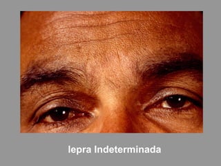 lepra Indeterminada
 