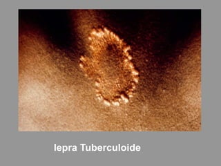 lepra Tuberculoide
 