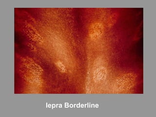 lepra Borderline
 