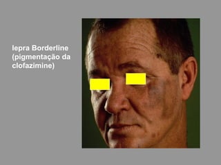lepra Borderline
(pigmentação da
clofazimine)
 