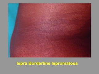lepra Borderline lepromatosa
 