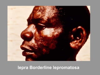 lepra Borderline lepromatosa
 