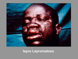 lepra Lepromatosa
 