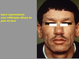 lepra Lepromatosa
com infiltração difusa da
pele da face
 