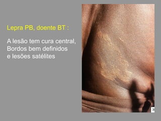 Lepra PB, doente BT :
A lesão tem cura central,
Bordos bem definidos
e lesões satélites
 