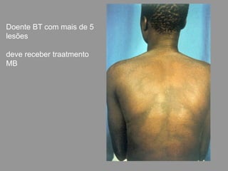 Doente BT com mais de 5
lesões
deve receber traatmento
MB
 