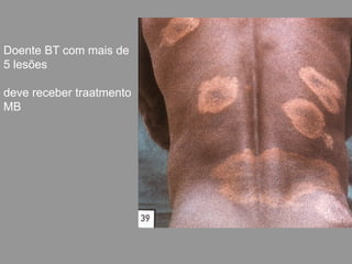 Doente BT com mais de
5 lesões
deve receber traatmento
MB
 
