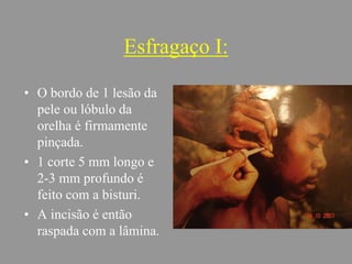 Esfragaço I:
• O bordo de 1 lesão da
pele ou lóbulo da
orelha é firmamente
pinçada.
• 1 corte 5 mm longo e
2-3 mm profundo é
feito com a bisturi.
• A incisão é então
raspada com a lâmina.
 
