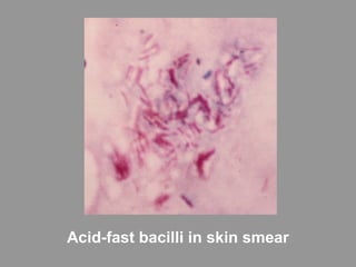 Acid-fast bacilli in skin smear
 
