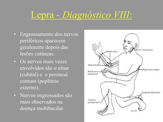 Lepra - Diagnóstico VIII:
• Engrossamento dos nervos
periféricos aparecem
geralmente depois das
lesões cutâneas.
• Os nervos mais vezes
envolvidos são o ulnar
(cubital) e o peroneal
comum (popliteio
externo).
• Nervos engrossados são
mais observados na
doença multibacilar.
 