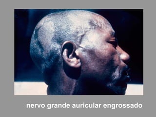 nervo grande auricular engrossado
 