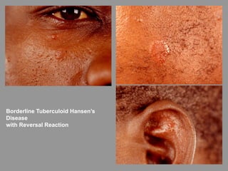 Borderline Tuberculoid Hansen’s
Disease
with Reversal Reaction
 
