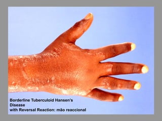Borderline Tuberculoid Hansen’s
Disease
with Reversal Reaction: mão reaccional
 